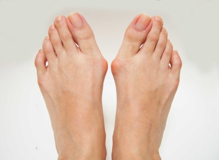 Haluksy na stopach? Nic straconego! Spróbuj masażu stóp!