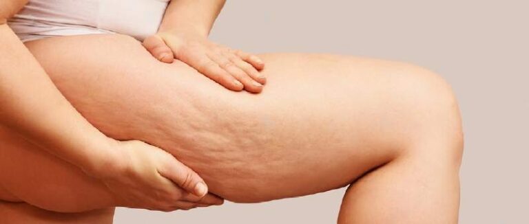 Cellulit – przyczyny i sposoby na tę powszechnie występującą zmianę skórną u kobiet.