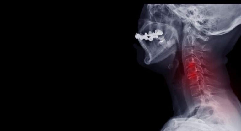 Stenoza szyjna: Przyczyny, zapobieganie i łagodzenie objawów