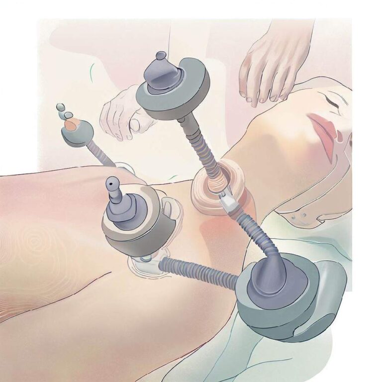 Zredukuj Cellulit: Przewodnik po Metodach i Zabiegach Kosmetycznych